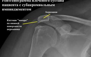 Импиджмент синдром в плечевом суставе