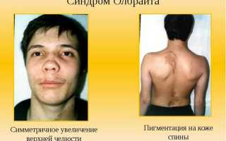 Люди с синдромом олбрайта фото