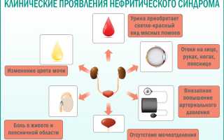 Нефротический синдром отличие от нефритического