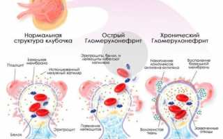 Хронический гломерулонефрит с мочевым синдромом лечение