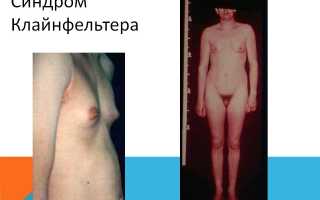 Синдром клайнфельтера код мкб