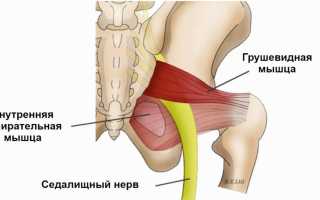 Чем снять синдром грушевидной мышцы