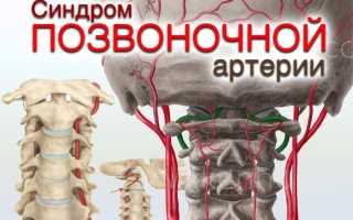 Синдром позвоночной артерии чем лечится
