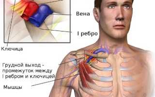 Двухсторонний синдром верхней апертуры грудной клетки