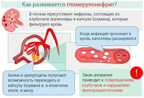 Хронический гломерулонефрит с мочевым синдромом лечение