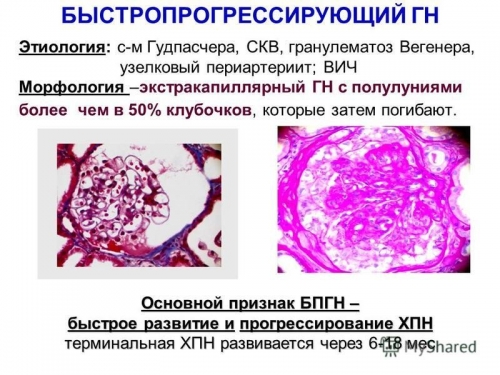 Хронический гломерулонефрит с мочевым синдромом лечение