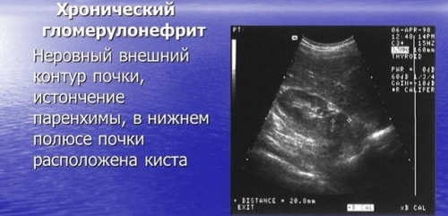 Хронический гломерулонефрит с мочевым синдромом лечение