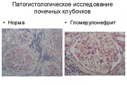 Хронический гломерулонефрит с мочевым синдромом лечение