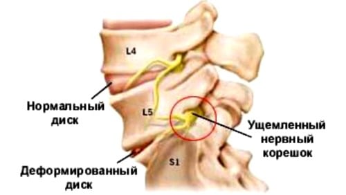 Лфк при поясничном остеохондрозе с корешковым синдромом