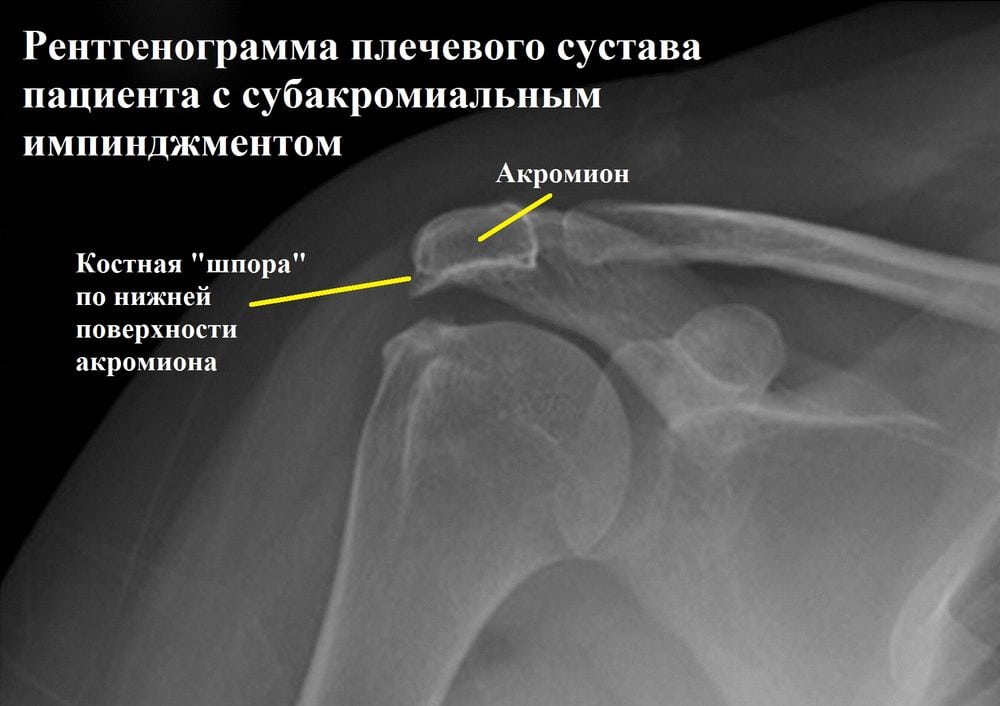 Импиджмент синдром в плечевом суставе
