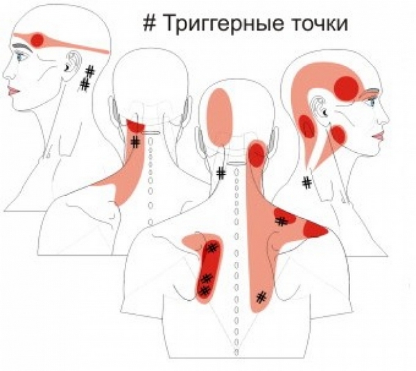 При миофасциальном болевом синдроме в мышцах возникают триггерные точки