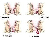 Хронический геморрой
