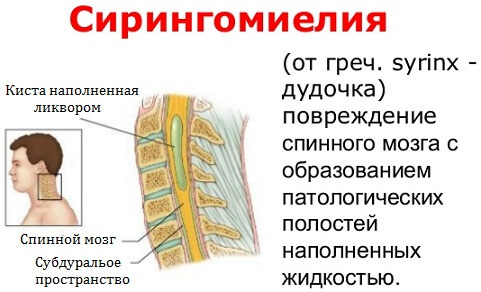 Фото детей с синдромом арнольда