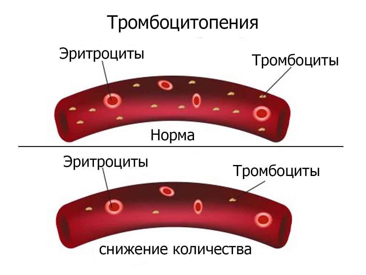 Тромбоцитопения без геморрагического синдрома при беременности что это