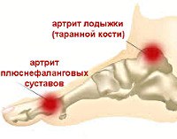 Артрит стопы