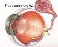 Ангиоспазм сетчатки