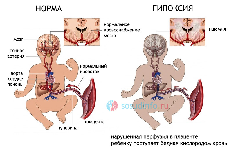 Диагноз резидуальная энцефалопатия с гипертензионным синдромом