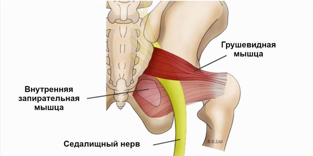 Чем снять синдром грушевидной мышцы