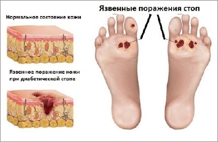 Синдром диабетической стопы симптомы фото
