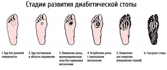 Синдром диабетической стопы симптомы фото