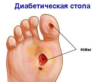 Синдром диабетической стопы симптомы фото