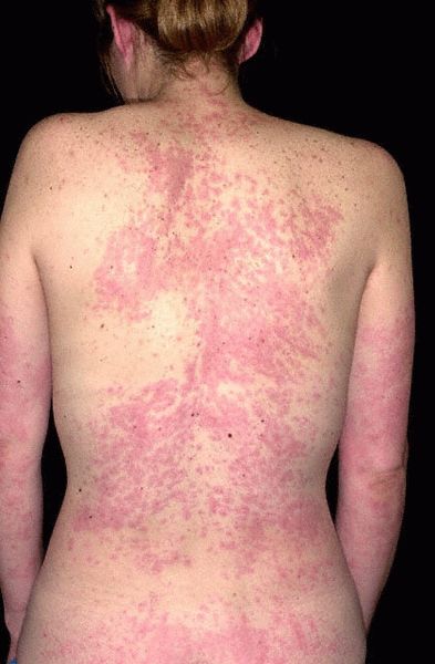 allergicheskaya-krapivnitsa-foto