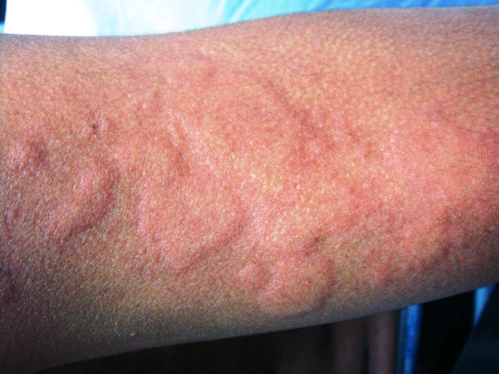 allergicheskaya-krapivnitsa-foto
