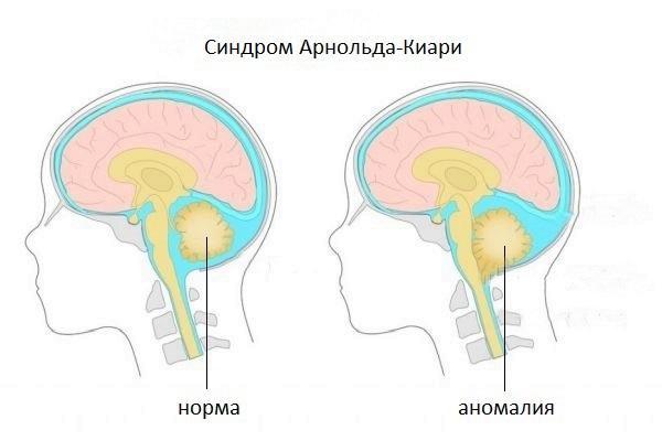 Фото детей с синдромом арнольда
