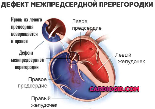 дефект-межпредсердной-перегородки