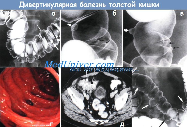 Дивертикулярная болезнь толстой кишки