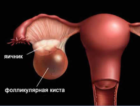 Фолликулярная киста
