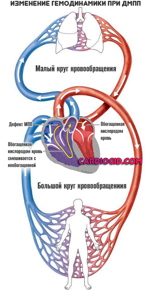 гемодинамика-при-дефекте-МПП