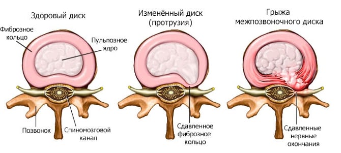 Лфк при поясничном остеохондрозе с корешковым синдромом