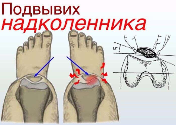 Нестабильность надколенника, наружный подвывих надколенника
