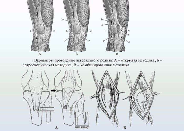 Нестабильность надколенника, наружный подвывих надколенника
