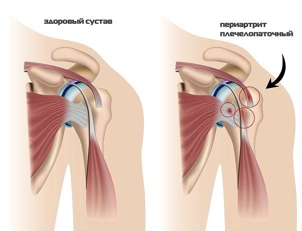 Лечение болевого синдрома плечевого сустава