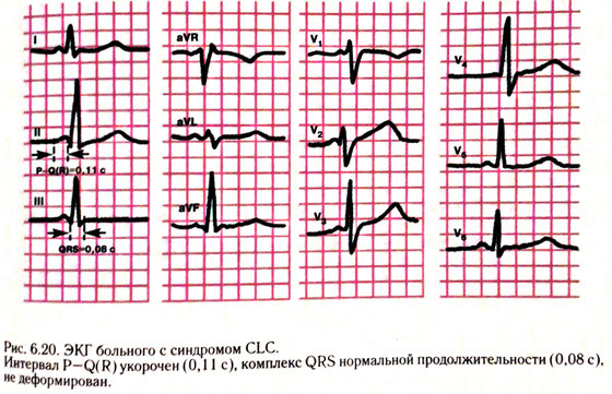 Что такое синдром clc в сердце
