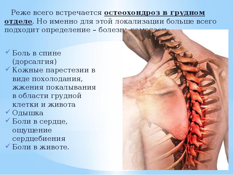 Лфк при поясничном остеохондрозе с корешковым синдромом