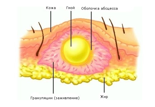 абсцесс на коже схема