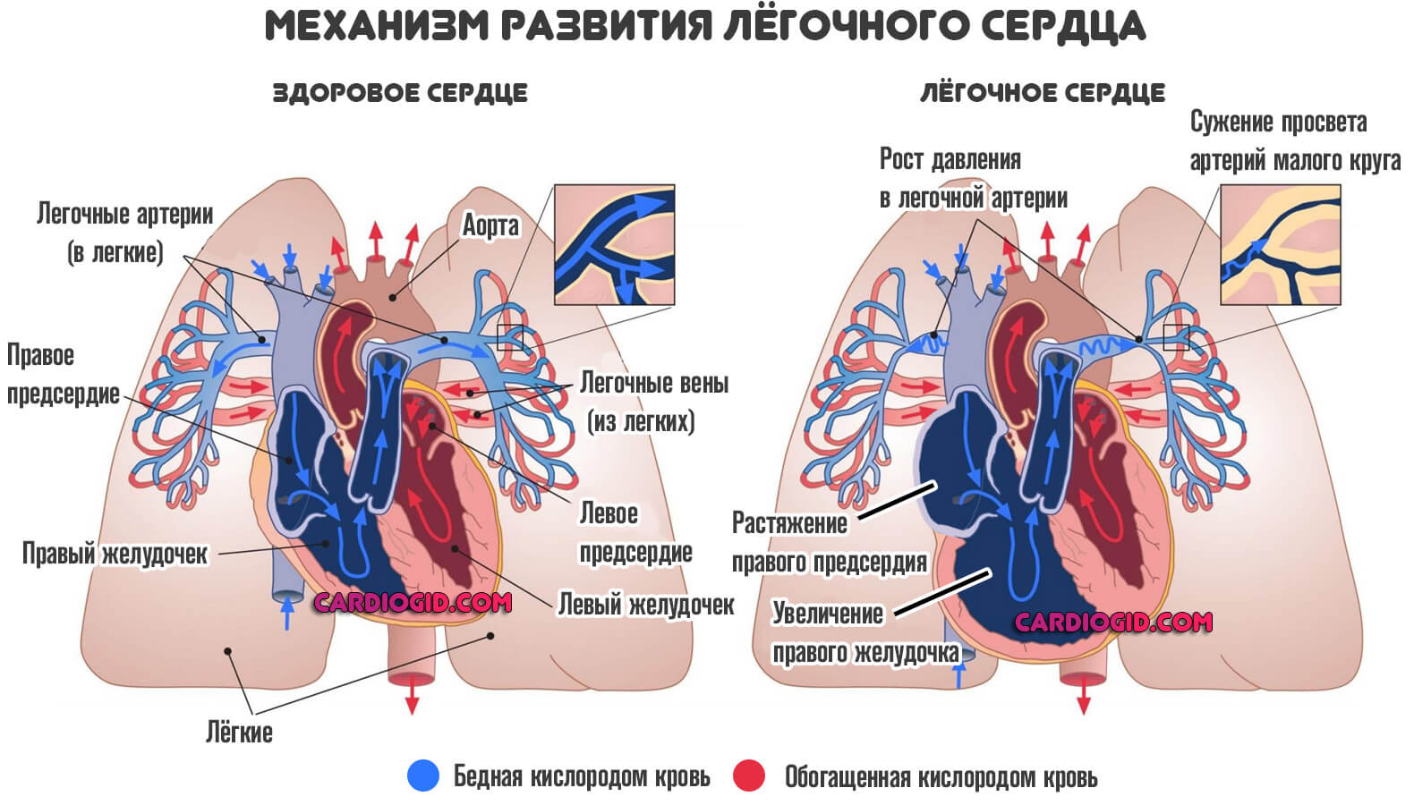 легочное-сердце