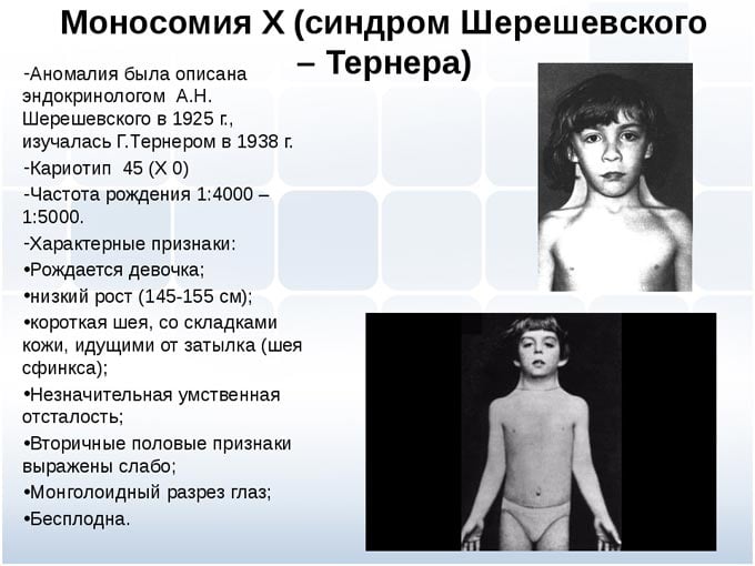 синдром Шерешевского-Тернера