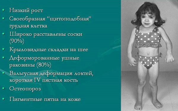признаки моносомии X