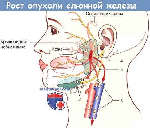 Рост опухоли слюнной железы