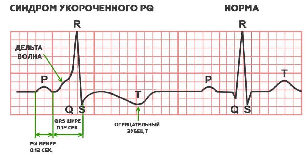 Синдром укороченного pq код по мкб 10