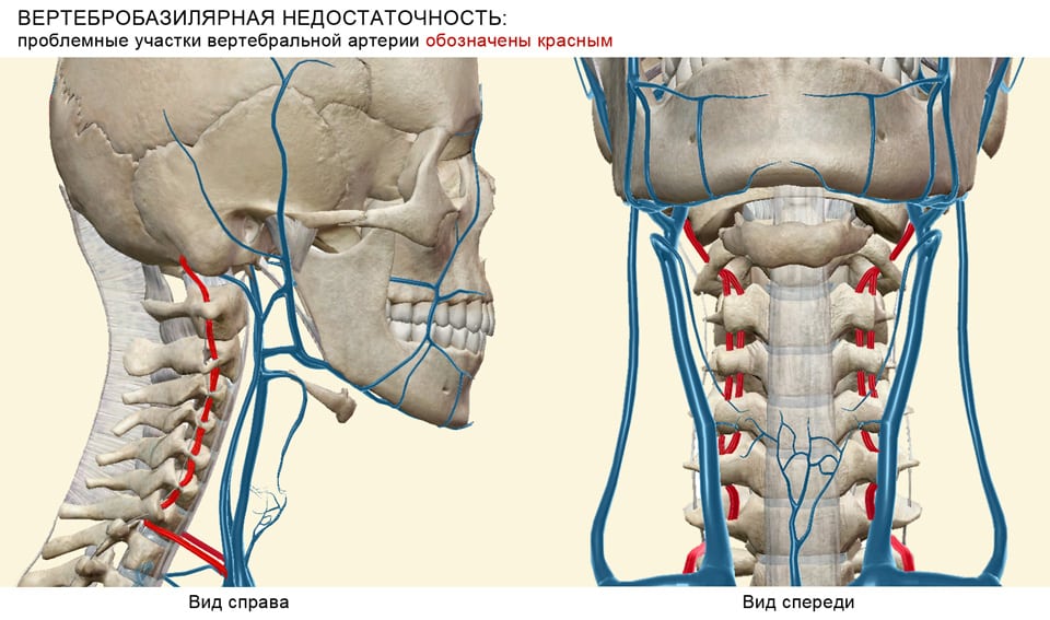 Шейный остеохондроз с синдромом вбн
