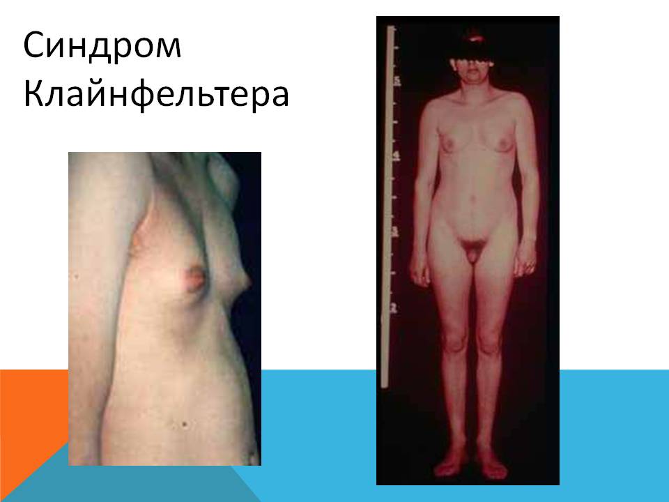Внешний вид больного с синдромом Клайнфельтера