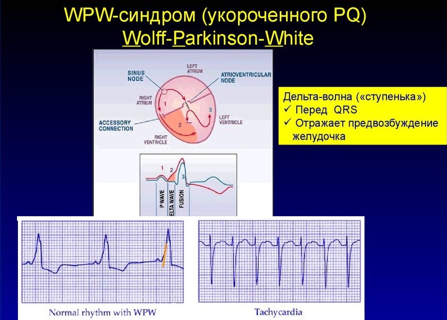 Синдром укороченного pq код по мкб 10